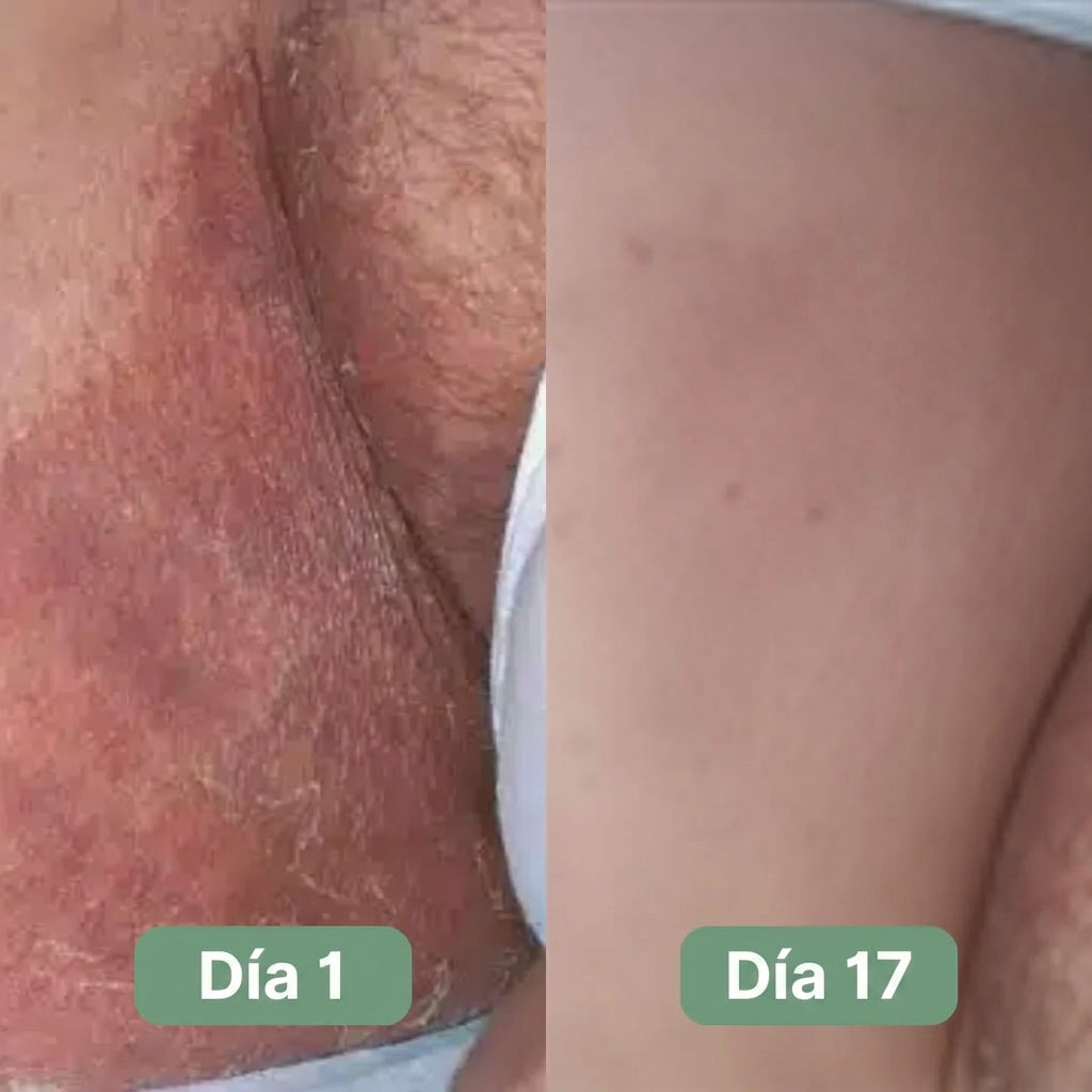 Jabón Veloma™ | Formula natural Antimicótica  - Anti Hongos - Antifúngica